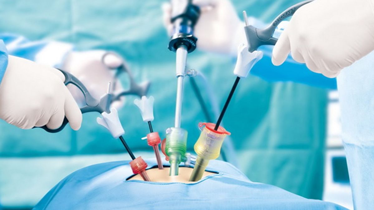 La cirugía laparoscópica consiste en realizar pequeñas incisiones (cortes) en el abdomen.