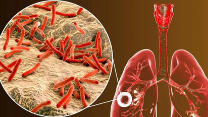 Tuberculosis: en un año, creció un 3,6% el índice de casos notificados en el país