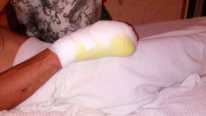 Tras ser atacado con una escopeta, le amputan dos dedos de una mano