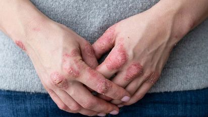 Psoriasis: en el país, más del 20% de los pacientes presenta formas severas de la enfermedad