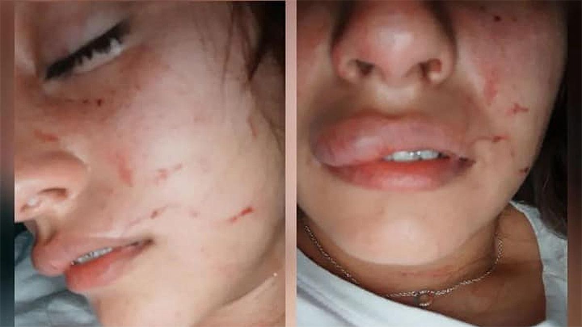 Melani Mauri publicó las imágenes de su rostro y cuerpo luego de un procedimiento policial en un boliche de Cabrera.