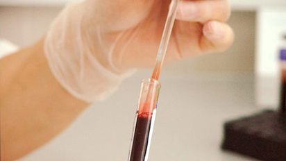 Un estudio sobre el sistema inmune de las personas con depresión abre el camino para diagnosticar la enfermedad a través de la sangre