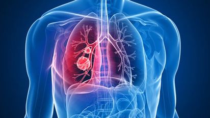 Con biomarcadores, ajustan precisiones para tratar distintas variantes de cáncer de pulmón