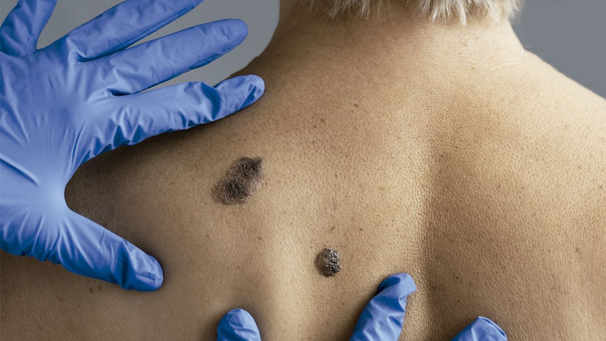 El diagnóstico temprano del melanoma es una herramienta determinante al momento de hablar del pronóstico de esta enfermedad.